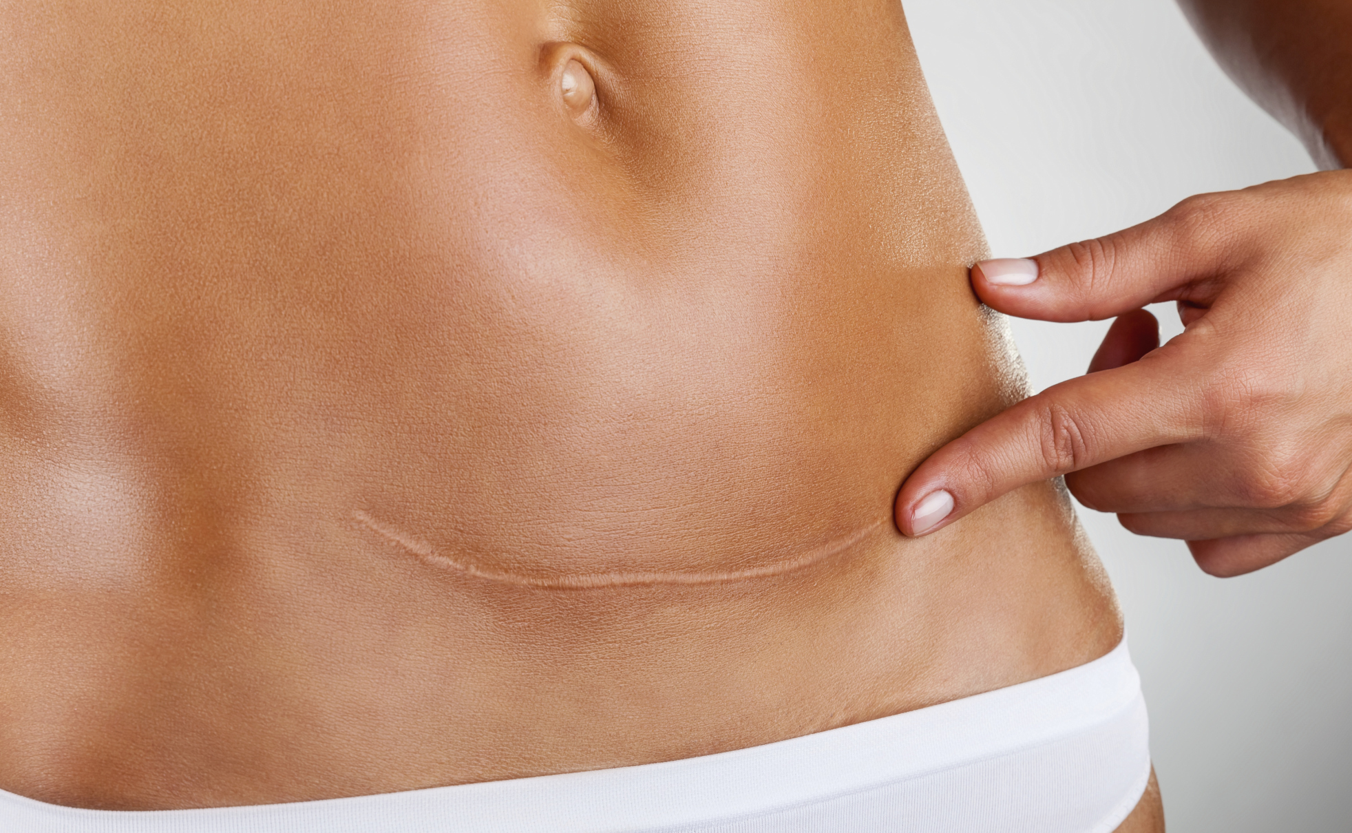 Scar of caesarean section