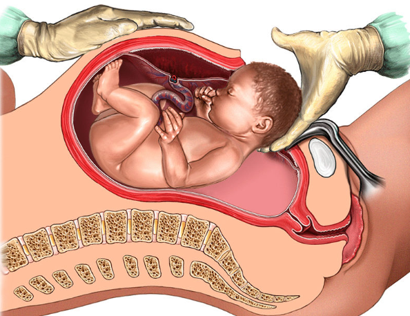 What is a C-Section?